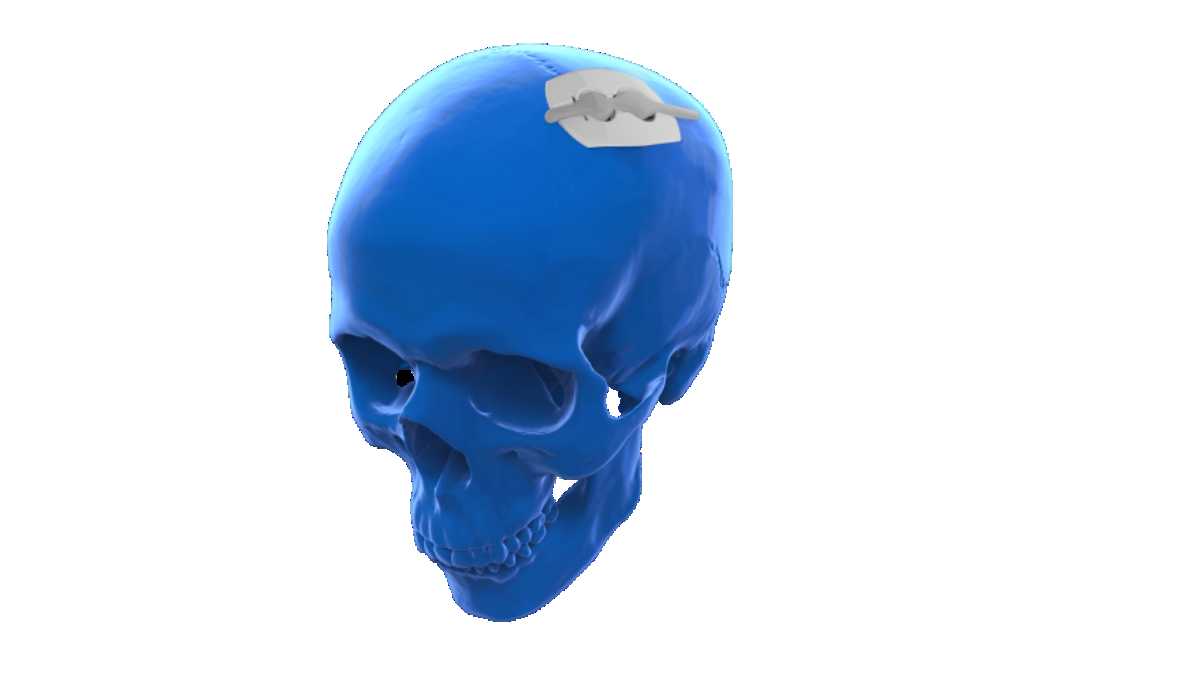 InvisiShunt Skull Model